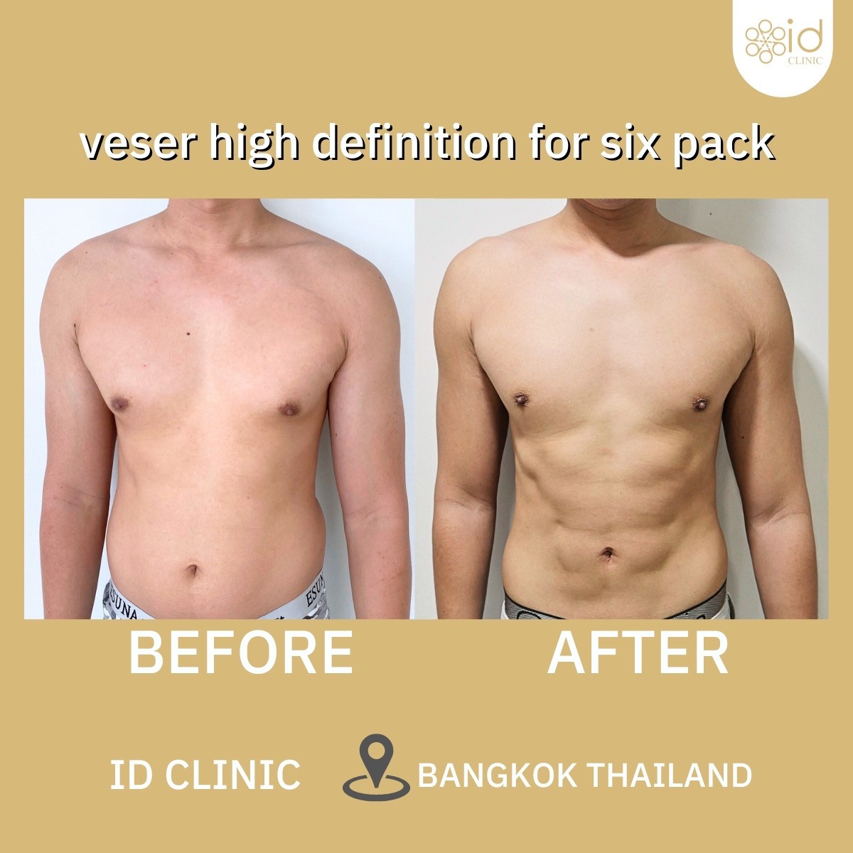 Vaser High Definition for Six pack